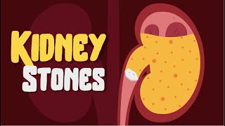 Kidney Pain How to treat Kidney Stones Causes and Symptoms [upl. by Imiaj]