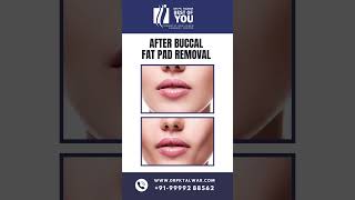 Buccal Fat Pad Removal Surgery Procedure  Buccal Fat Removal Surgery In Delhi  Dr PK Talwar [upl. by Esnahc]