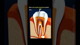 How Root Canal Treatment Works rootcanals howrootcanalworks rootcanal [upl. by Dylan]