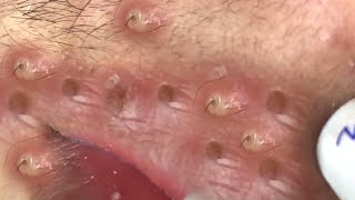 Clean Giant Blackheads on on the Lips [upl. by Aryajay]