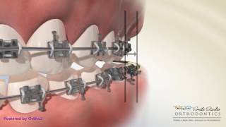 Elastics  Crossbite  Orthodontic Treatment [upl. by Ilera]