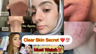 Best Treatment for Acne Dark Spots Pigmentation and Scars  Dermatologist Recommended Products [upl. by Jaylene]