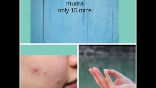 how to remove pimple forever with Varun mudraGet healthy skin and hair [upl. by Alo208]