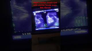 Right overian simple cyst with uterine fundal mass ultrasound ultrasoundimages humanhealthandd [upl. by Yelnats903]