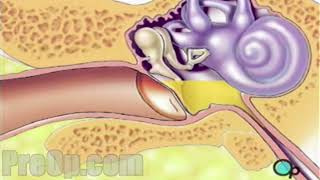 Myringotomy Insertion of Tube Surgery PreOp® Patient Education [upl. by Free]