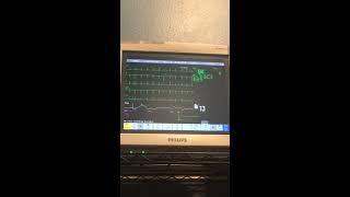 Philips IntelliVue MP70 ECG with extrasystoles [upl. by Kristo540]