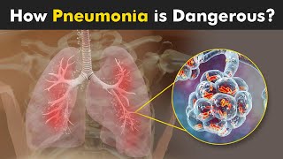 What Happens in Pneumonia  Symptoms Causes and Treatment 3D Animattion [upl. by Naahsar626]