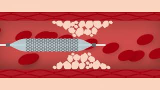 Heart Stent Procedure [upl. by Engamrahc]