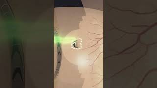 Laser photocoagulation around retinal tear laser eyes eyecare eyesurgery [upl. by Alakcim]