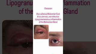 Chalazion  eyelid shorts ytshorts education nainaeyecare❤❤ [upl. by Stoffel]