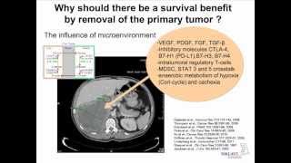 Cytoreductive Nephrectomy Survival Impact of Surgery in mRCC Axel Bex MD PhD [upl. by Helban785]