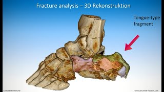 Technique of minimalinvasive treatment on a calcaneal fracture  Tonguetype [upl. by Mayes499]