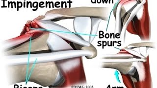 Shoulder Impingement Signs and symptoms [upl. by Nosyrb]