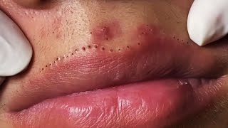 Lips Blackhead removal Video 53 Blackheads blackheadsremoval sebum [upl. by Lachus]