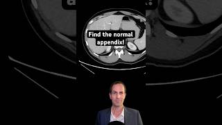 Abdominal CT Tutorials  Find the Normal Appendix [upl. by Alber298]