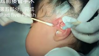 Preauricular Fistula Surgery（Part fiveEnd of surgery）耳前瘘管手术（第五部分：完成）20230815 [upl. by Weinberg]