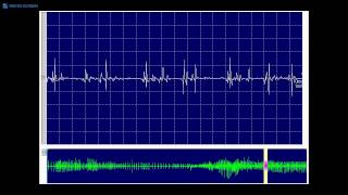 Kimura amp Kohara F61 A highamplitude shortduration spiky MUP seen in IBM [upl. by Nwahsram]