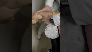 FRACTURA LUXACION DE CODO ELBOW FRACTURE DISLOCATION [upl. by Watt]