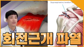 회전근개 파열이 너무 광범위할 때는 [upl. by Karwan]