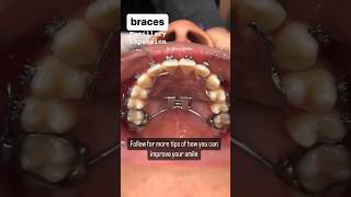 Maxillary Expansionnarrow jaw viral youtubeshorts oralhealth dentist fashion trending twitch [upl. by Oaht669]