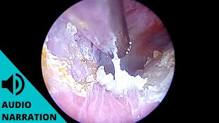 Infection causes ear to fill with dead skin acute diffuse desquamation explained [upl. by Notselrahc]