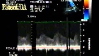 patent ductus arteriosus 3 [upl. by Leunam]