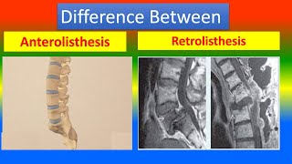 Difference Between Anterolisthesis and Retrolisthesis [upl. by Halak]