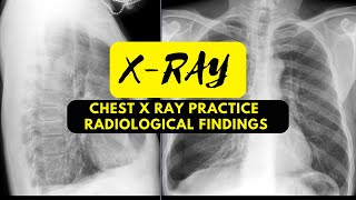 Chest X Ray Practice 37  Radiological Findings Bronchitis [upl. by Naneik]