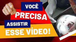 como tratar uma criança com mordida cruzada  chegou o aparelho para resolver  sai confiante [upl. by Rooke]