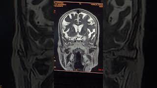 Brain me sag ki planning anatomy learningradiology diagnosticimaging like diagnosticradiology [upl. by Ansell]