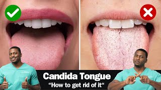 How To Fix A CANDIDA Yeast Overgrowth  Including Best Antifungal Herbs [upl. by Sidnac983]