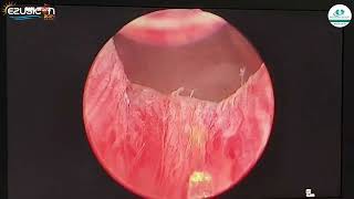 EZUSICON2024 33RD ANNUAL CONFERENCE Of Urological Society of India lLIVE Demonstration [upl. by Beulah]