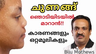 ശരീരത്തിലെ ചുണങ്ങ് അതിവേഗം മാറാന്‍ ചില ഒറ്റമൂലികള്‍  Natural remedies for tinea versicolor [upl. by Kwei]