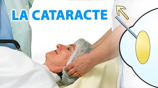 La cataracte expliquée par Dr Stopek [upl. by Mali]