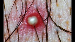 Whitehead or Ingrown Hair What is this Dr Poppers Pimples Cysts Boils [upl. by Ahsotal]