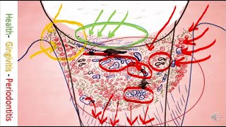 Periodontitis Cure by Bonner Method microscope caricature and drawing Gum disease [upl. by Hurley483]