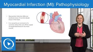 Myocardial Infarction MI Pathophysiology – MedSurg Nursing  Lecturio Nursing [upl. by Anelat952]