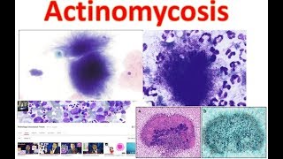 Actinomycosis Medschooltutorial [upl. by Imotih]