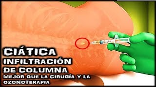 CIÁTICA Y LA VERDADERA CURA CON INFILTRACIÓN DE COLUMNA LUMBAR MEJOR QUE CIRUGÍA Y OZONOTERAPIA [upl. by Bekaj]