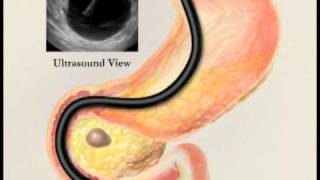 Endoscopic Ultrasound with Fine Needle Aspiration Biopsy [upl. by Anoet]