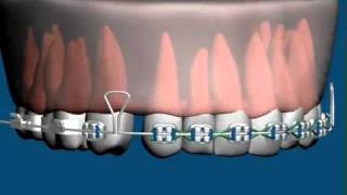 ORTODONCIA CERRAR ESPACIO [upl. by Wolfie]