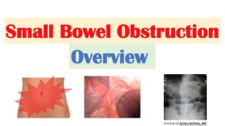 Small Bowel Obstruction SBO  Risk Factors Causes Signs amp Symptoms Diagnosis Treatment [upl. by Sudderth]