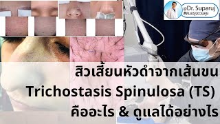 คล้ายสิวแต่ไม่ใช่สิว แต่เป็นสิวเสี้ยนหัวดำจากเส้นขน Trichostasis Spinulosaหมอรุจชวนคุยรักษาสิวเสี้ยน [upl. by Seidule128]