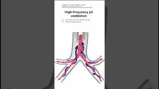 Highfrequency jet ventilation [upl. by Michey775]