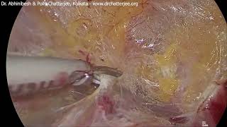 TLH BSO IN PELVIC ABSCESS [upl. by Savvas]