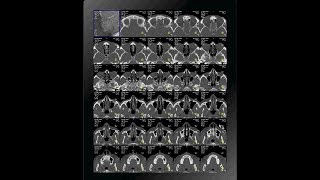 CT scan of pns filming [upl. by Adnil]