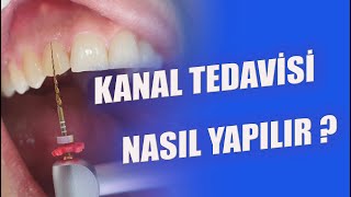 Kanal Tedavisi Nasıl Yapılır Nelere Dikkat Edilir [upl. by Sadye549]