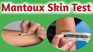 Mantoux test  Tuberculin skin test  Tuberculin test [upl. by Inattyrb]