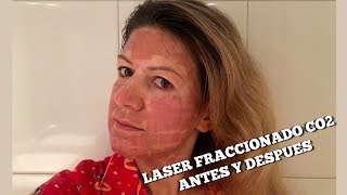 Laser fraccionado CO2 acne manchas y rejuvenecimiento  1 experiencia [upl. by Trout218]