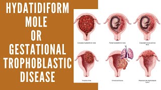 Hydatidiform Mole  Vesicular Mole  Molar Pregnancy  Gestational Trophoblastic Disease [upl. by Nemracledairam]